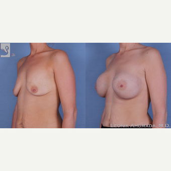 25-34 year old woman treated with Breast Augmentation after 3093449