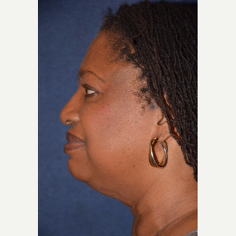 65-74 year old woman treated with Neck Lift before 3490152