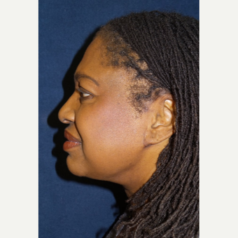 65-74 year old woman treated with Neck Lift after 3490152
