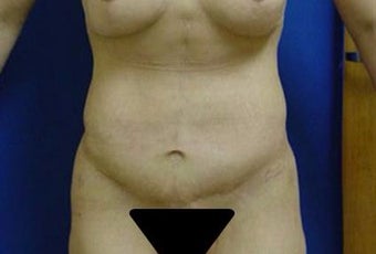 35-44 year old woman treated with Liposuction after 3283450