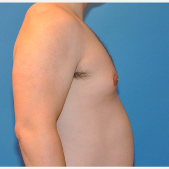26 Year old male with Gynecomastia Treated with Breast Reduction before 3705429
