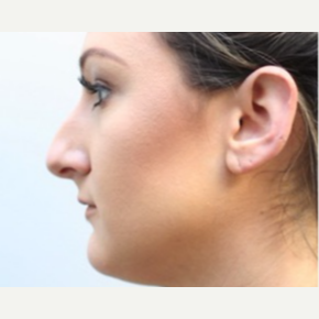 25-34 year old woman treated with Rhinoplasty before 3747747