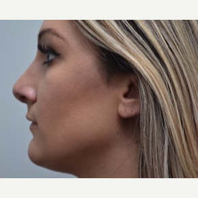 25-34 year old woman treated with Rhinoplasty after 3747747