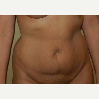 45-54 year old woman treated with Tummy Tuck before 3365614