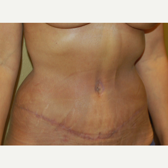 45-54 year old woman treated with Tummy Tuck after 3365614