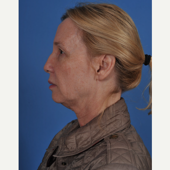 55-64 year old woman treated with Facelift before 3437567