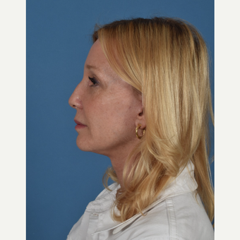 55-64 year old woman treated with Facelift after 3437567