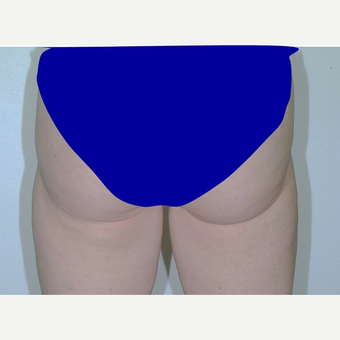 25-34 year old woman treated with Liposuction after 3346065