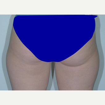 25-34 year old woman treated with Liposuction before 3346065
