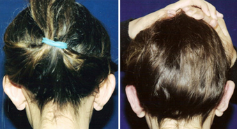 Ear Surgery before 1430424