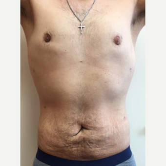 25-34 year old man treated with Smart Lipo after 3370525
