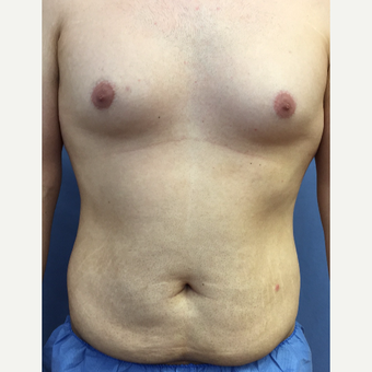 25-34 year old man treated with Smart Lipo before 3370525