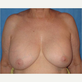 65-74 year old woman treated with Breast Implant Removal before 3738950
