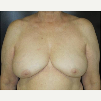 65-74 year old woman treated with Breast Implant Removal after 3738950