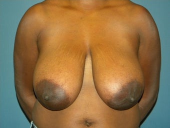 32DDD with back, neck and shoulder pain before 1067320