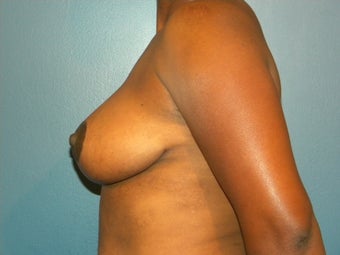 32DDD with back, neck and shoulder pain 1067320