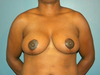 32DDD with back, neck and shoulder pain after 1067320