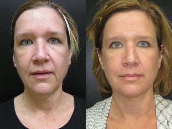 53 year old woman treated with Ulthera after 684606