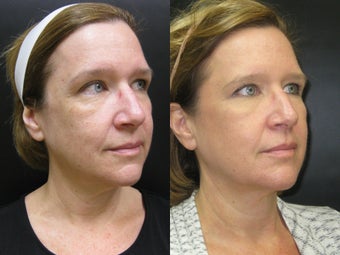 53 year old woman treated with Ulthera before 684606