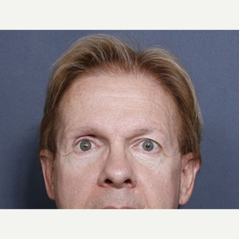 55-64 year old man treated with Ear Surgery (view 1 of 2) before 3180686