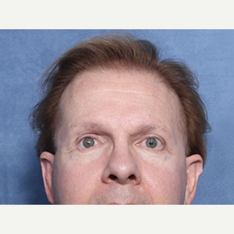 55-64 year old man treated with Ear Surgery (view 1 of 2) after 3180686