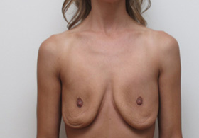25-34 year old woman treated with Breast Implant Removal after 1946291