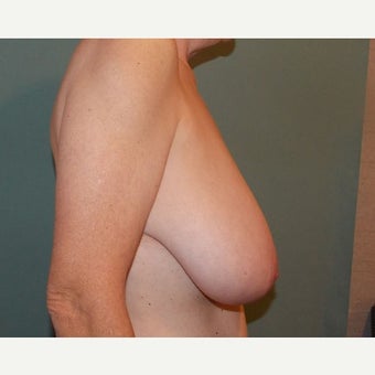 45-54 year old woman treated with Gender Reassignment Surgery 1596423
