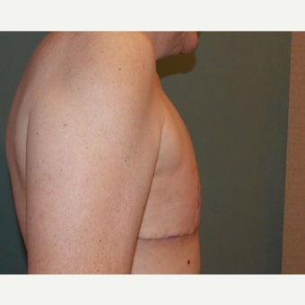 45-54 year old woman treated with Gender Reassignment Surgery 1596423