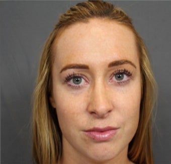 IPL, Limelight Laser after 3649819