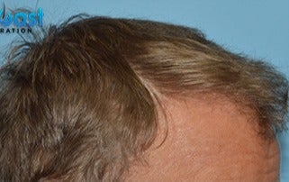 45-54 year old man treated with Hair Transplant after 3141773