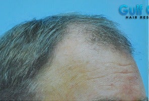 45-54 year old man treated with Hair Transplant before 3141773