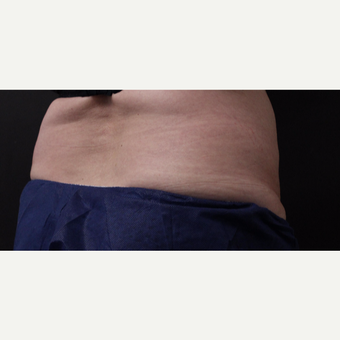 59 year old woman treated with CoolSculpting before 3384619