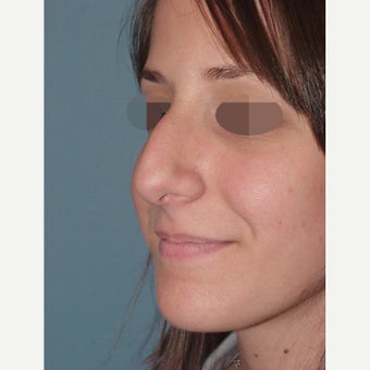 18-24 year old woman treated with Rhinoplasty & Sinus Surgery for a Deviated Septum before 2172197