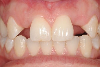 Patient with missing upper lateral incisors replaced with dental implants before 1441443