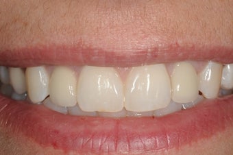 Patient with missing upper lateral incisors replaced with dental implants after 1441443