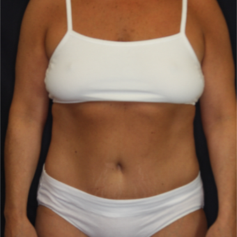 45-54 year old woman treated with Tummy Tuck after 3075277