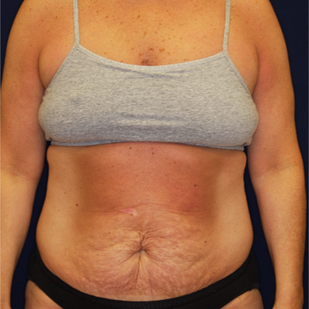 45-54 year old woman treated with Tummy Tuck before 3075277
