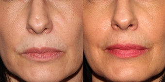 Fraxel Re:Store for Facial Rejuvenation before 1317962