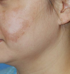 Co2 laser resurfacing before 1432755