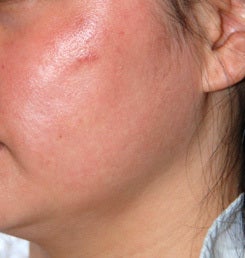 Co2 laser resurfacing after 1432755