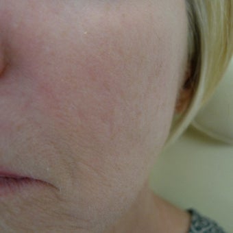 Acne scars treated with subcision and filler- no laser! after 2380472