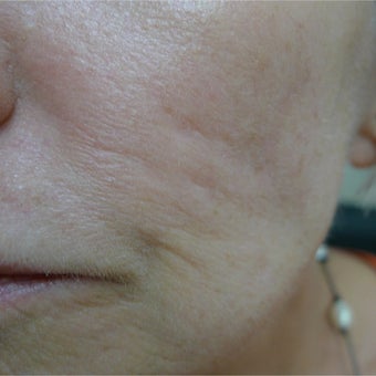 Acne scars treated with subcision and filler- no laser! before 2380472