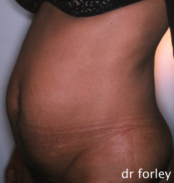 36 year old female 4 months following a tummy tuck before 625034