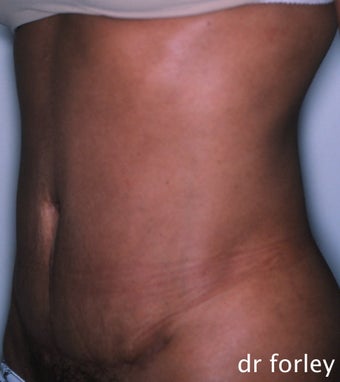 36 year old female 4 months following a tummy tuck after 625034
