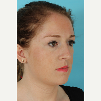 25-34 year old woman treated with Rhinoplasty before 3691198
