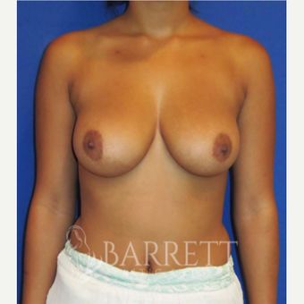18-24 year old woman treated with Breast Implants before 3584236