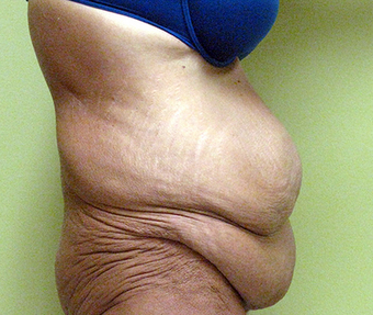 Patient who lost over 100 pounds got a trunk lift with liposuction 1381859