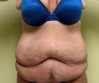 Patient who lost over 100 pounds got a trunk lift with liposuction before 1381859