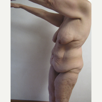 45-54 year old woman treated with Body Lift before 3634172