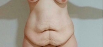 25-34 year old woman treated with Tummy Tuck before 2473250